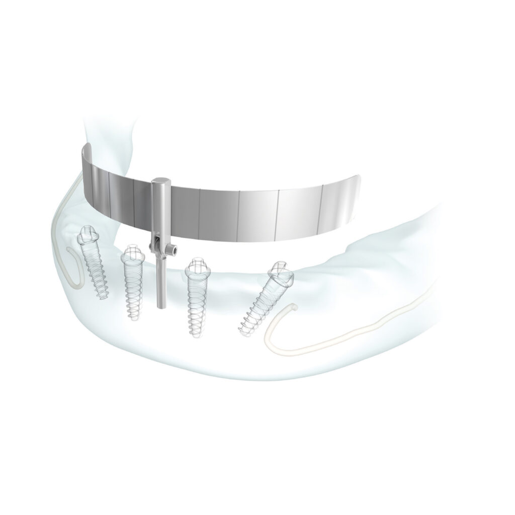 JD Surgical Kits and Instruments Archivi JDentalCare