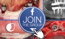 Usciti al gruppo FB “Together JD Implants”