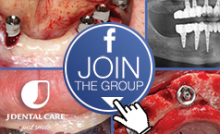 Join the FB group “Together JD Implants”