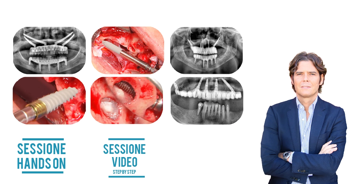 Porta le tue abilità nel trattamento dei full arch ad un livello successivo. Padroneggia l’estremo con Maxilla-For-All®.