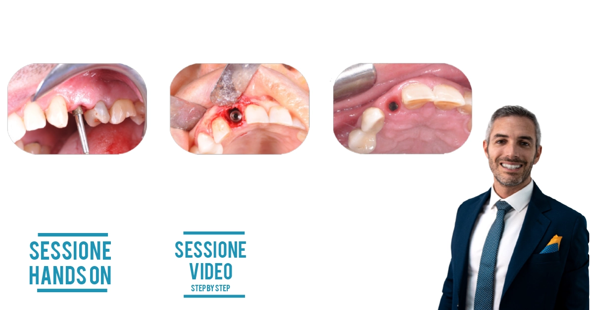 L’impianto post estrattivo in zona estetica. Dalla pianificazione alla finalizzazione