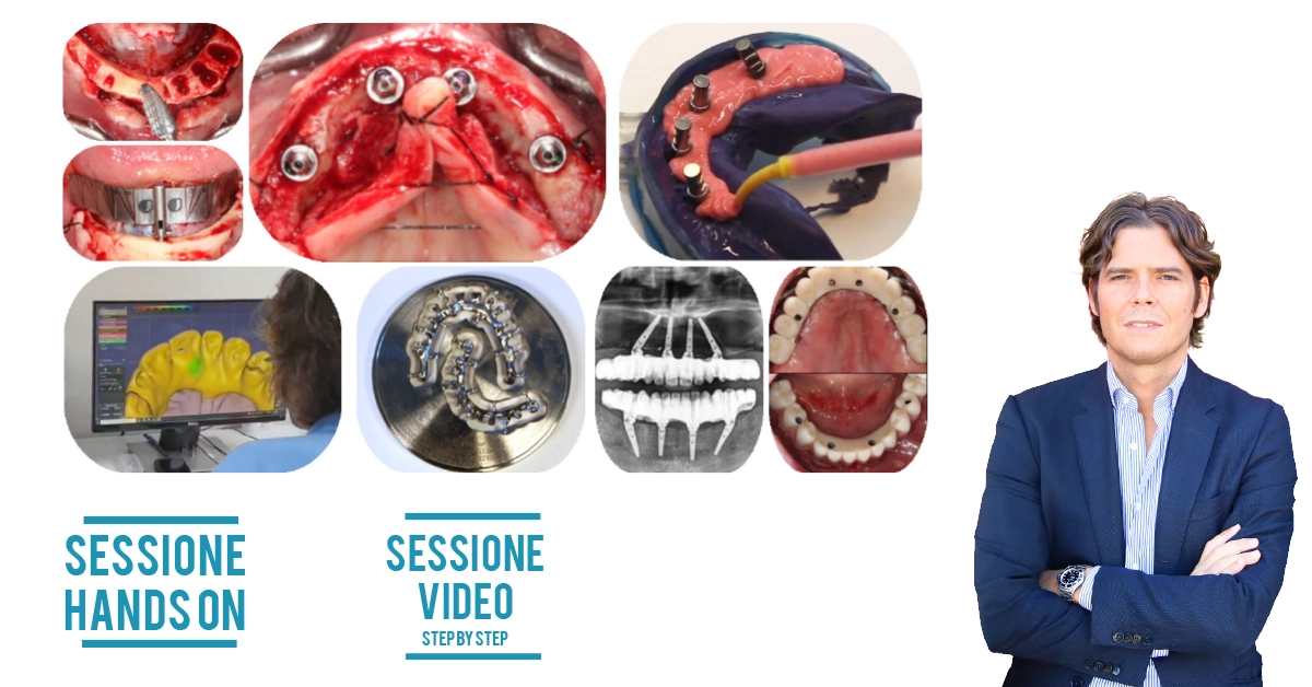La riabilitazione immediata full arch on 4/6 con l’uso degli impianti tiltati. Azzera lo stress e porta a casa un protocollo standardizzato da attuare nella routine.