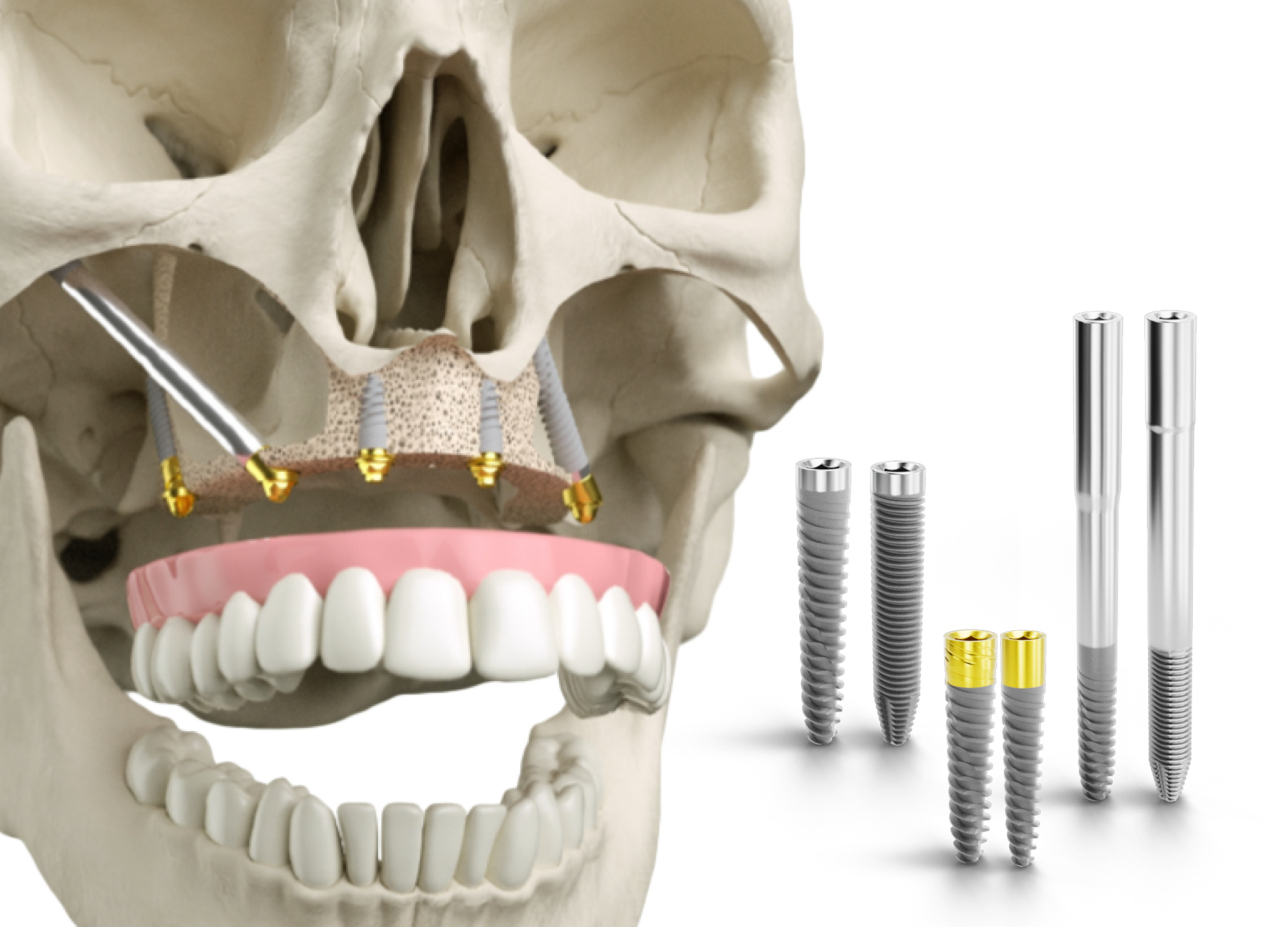 Maxillary deals