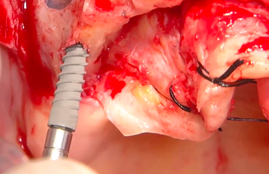 JD Nasal implants