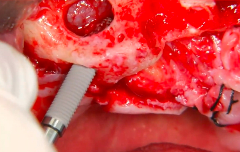 JD Nasal implants