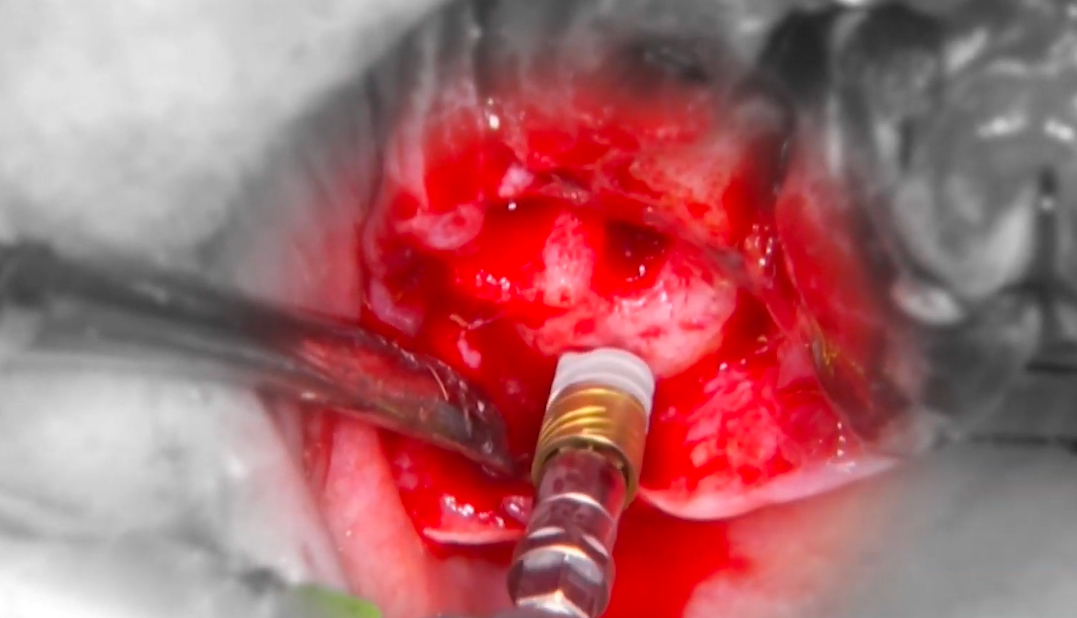 JDPterygo implants