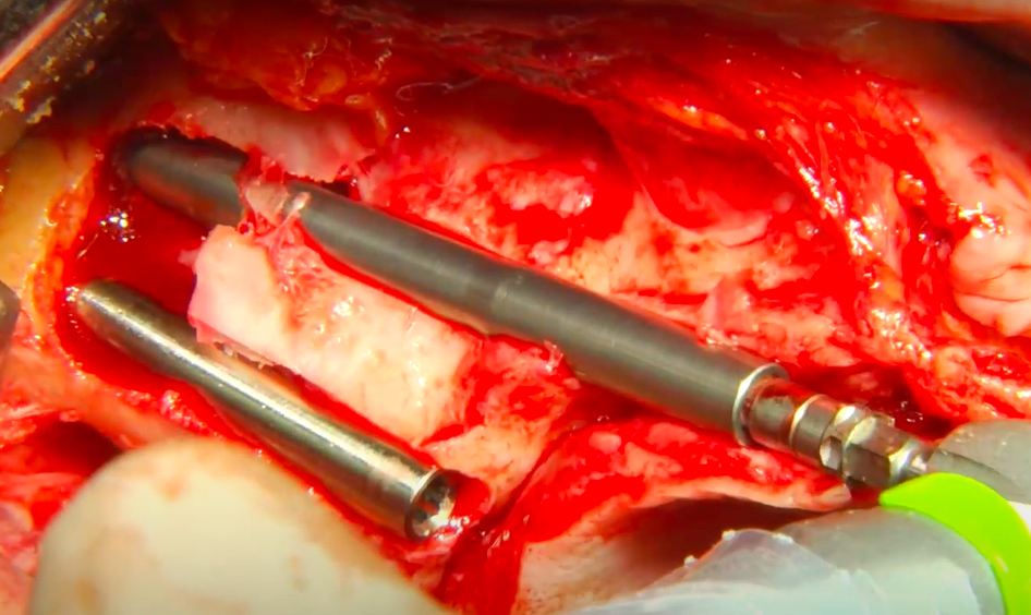 JD Zygoma implants