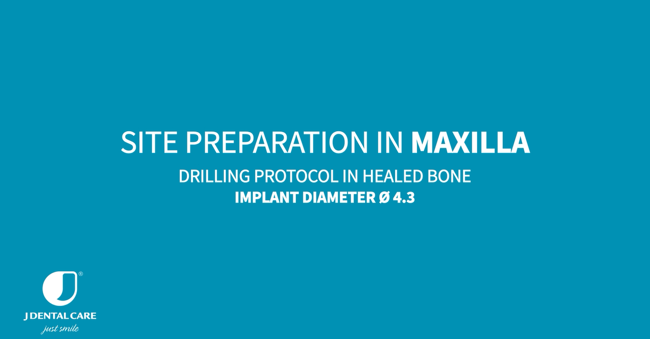 Implant Ø4.3 L13 – site preparation in maxilla and mandible