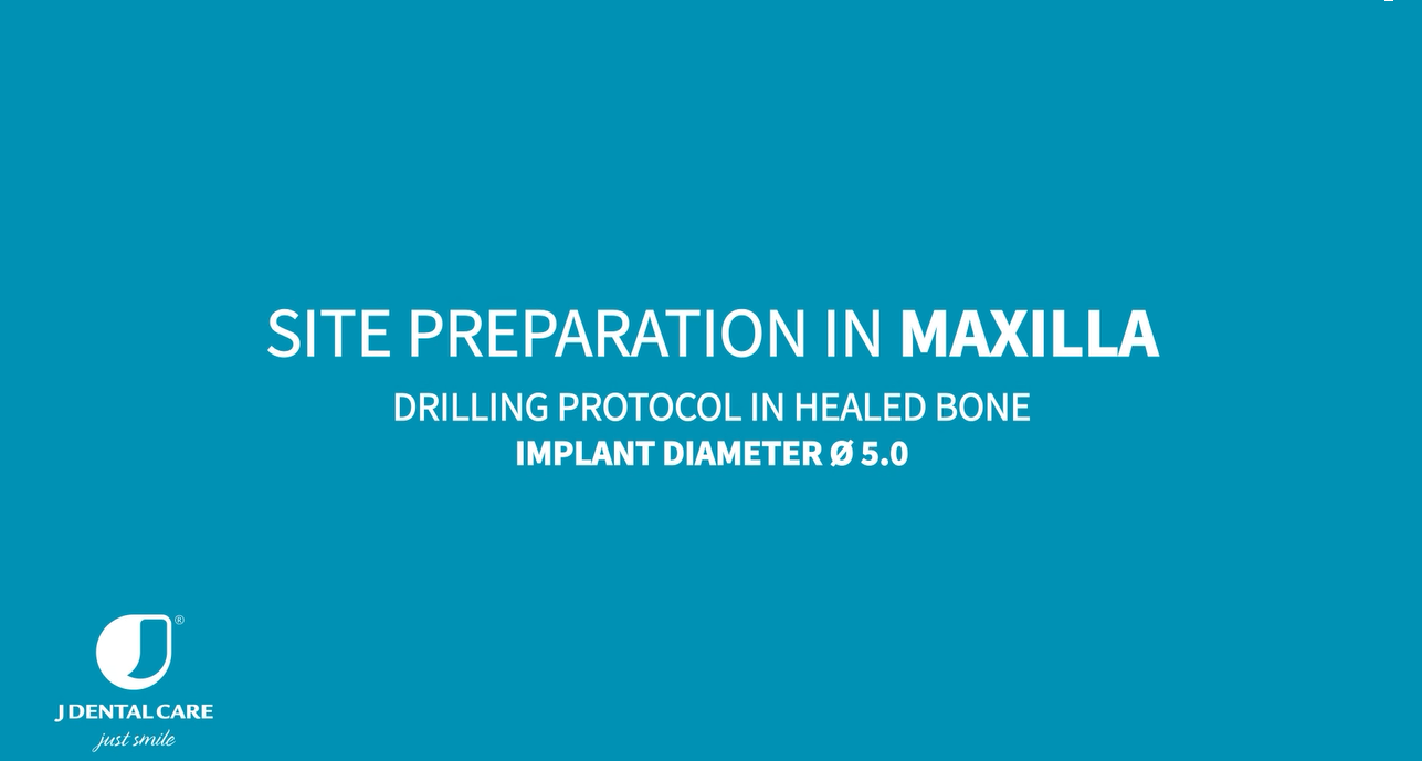 Implant Ø5.0 L13 – site preparation in maxilla and mandible