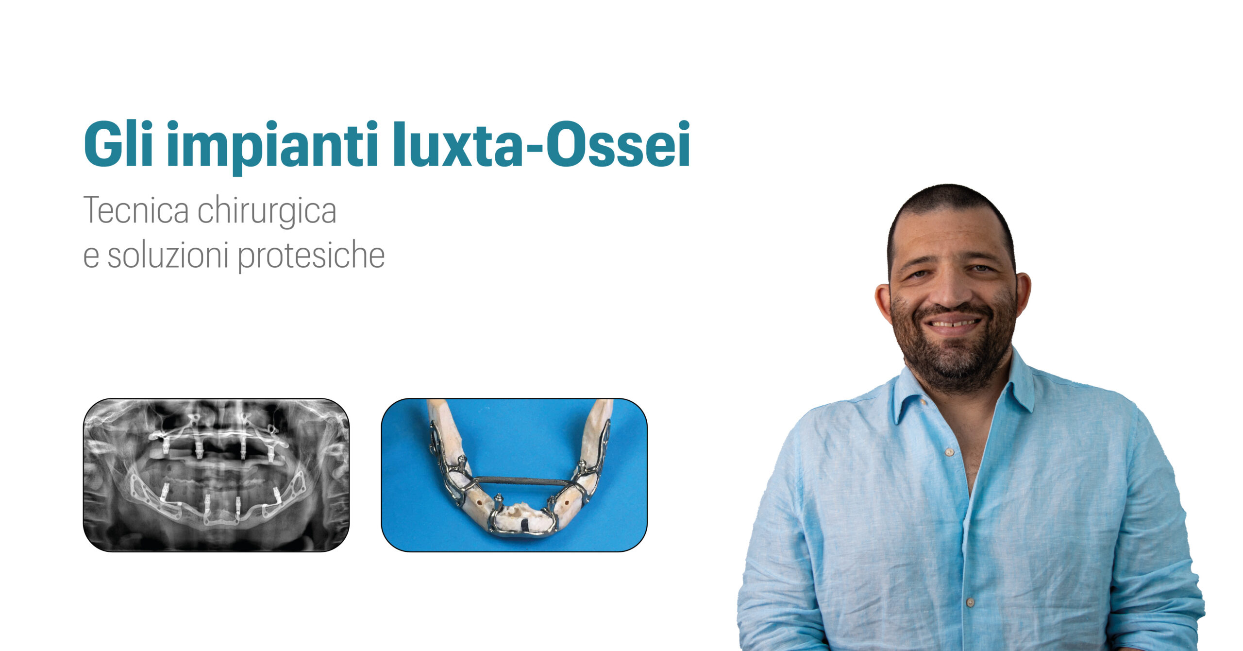 Gli impianti iuxtaossei: tecnica chirurgica e soluzioni protesiche con Live Surgery