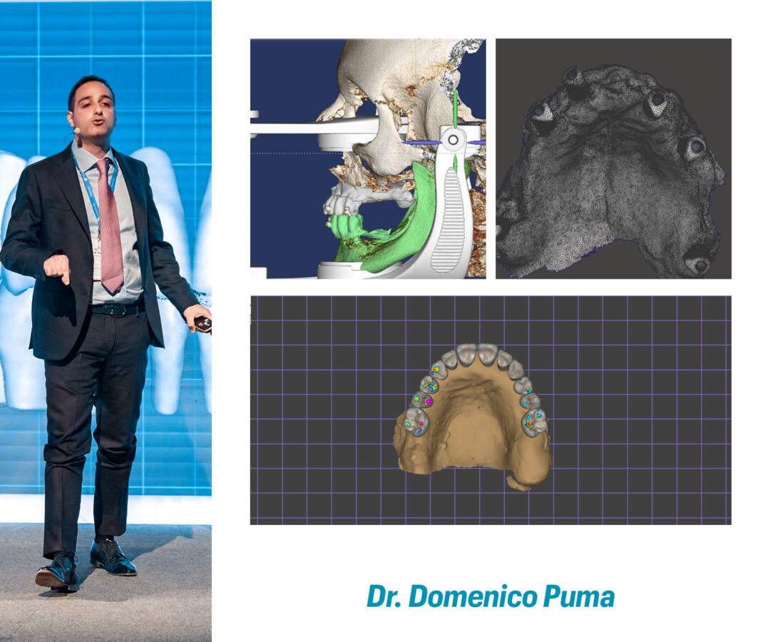 PROTOCOLLO FULL DIGITAL NELL’IMPLANTOLOGIA A CARICO IMMEDIATO CON IMPIANTI JD:  un protocollo semplificato, veloce e poco invasivo per la gestione chirurgico/protesica anche dei casi più complessi