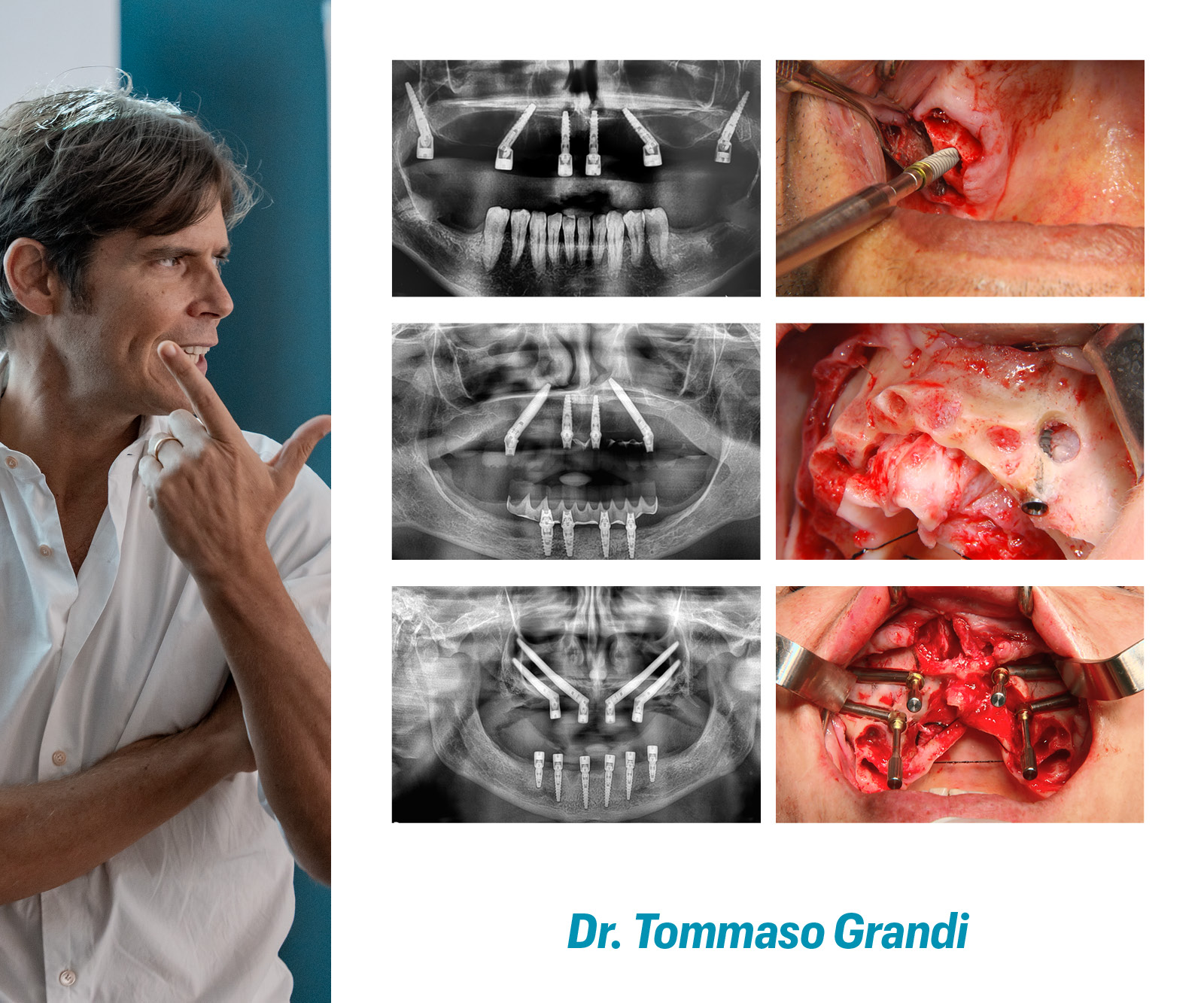 PORTA LE TUE ABILITÀ NEL TRATTAMENTO DEI FULL ARCH AD UN LIVELLO SUCCESSIVO: padroneggia l’estremo con Maxilla-For-All®.