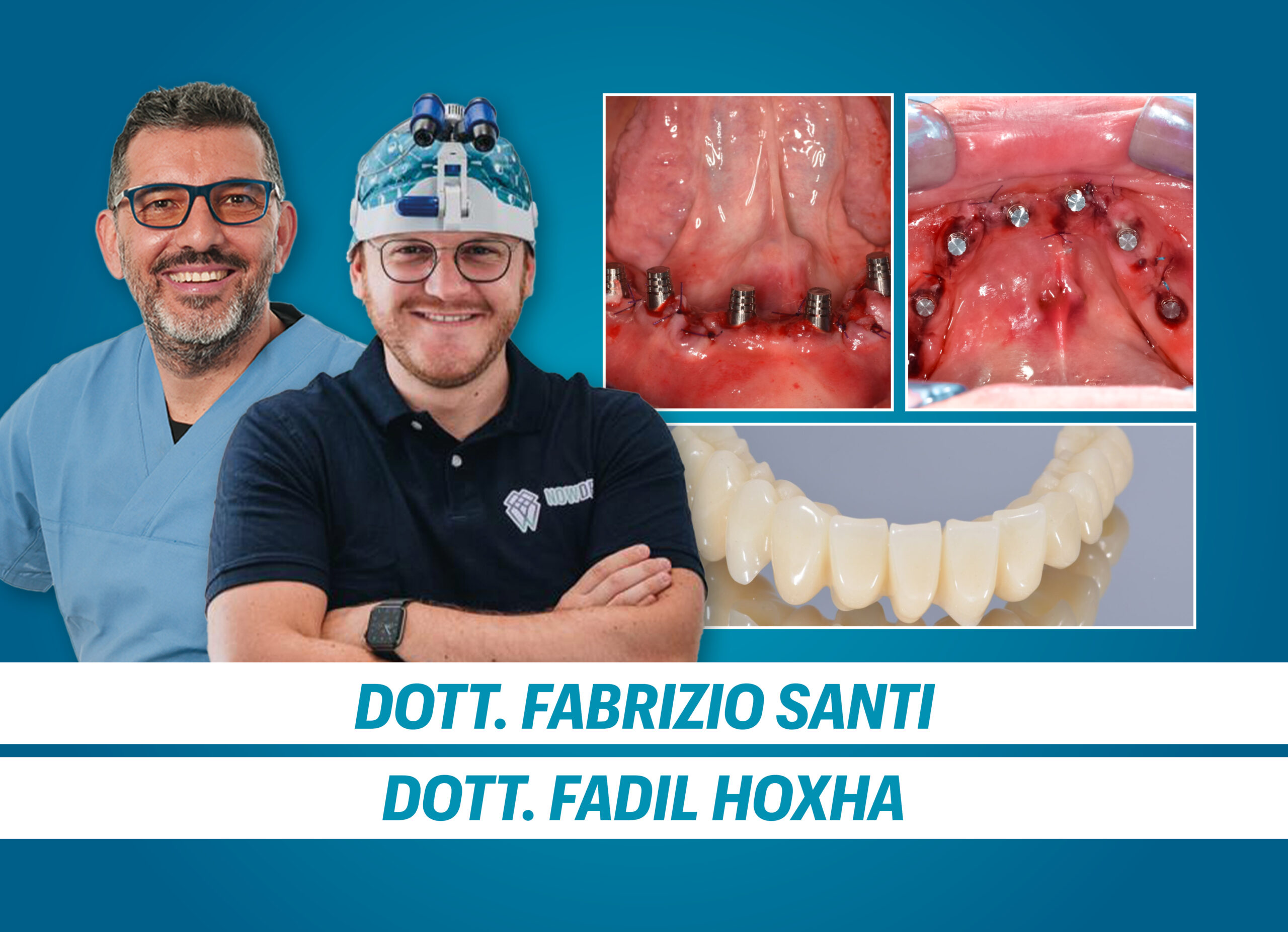 LA PROTESI FISSA CONOMETRICA: il concetto, i vantaggi, le indicazioni, i protocolli clinici