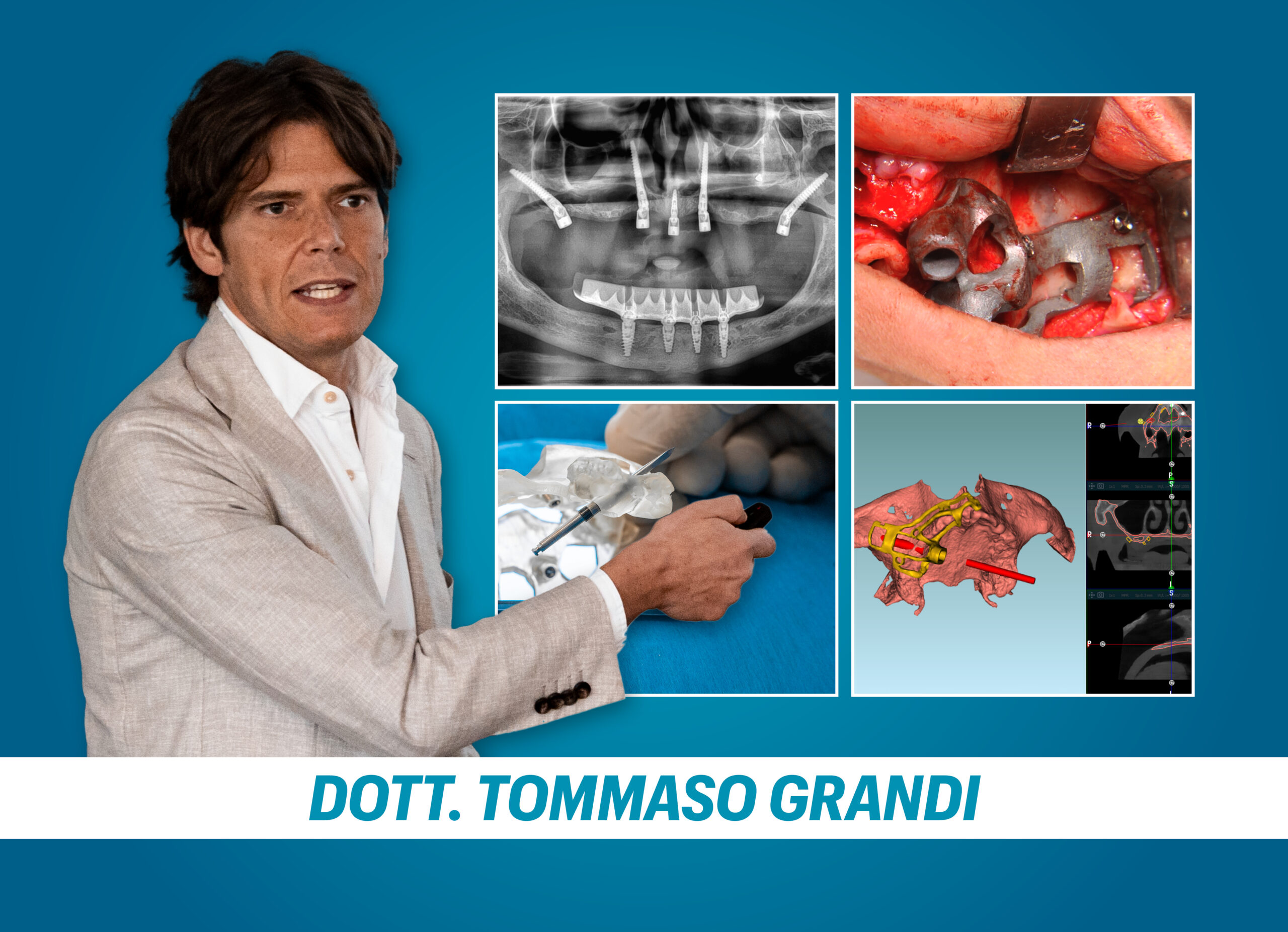 NUOVE POSSIBILITA’ DI POSIZIONAMENTO IMPLANTARE FULLY GUIDED NEI PILASTRI DEL MASCELLARE GRAVEMNTE ATROFICO