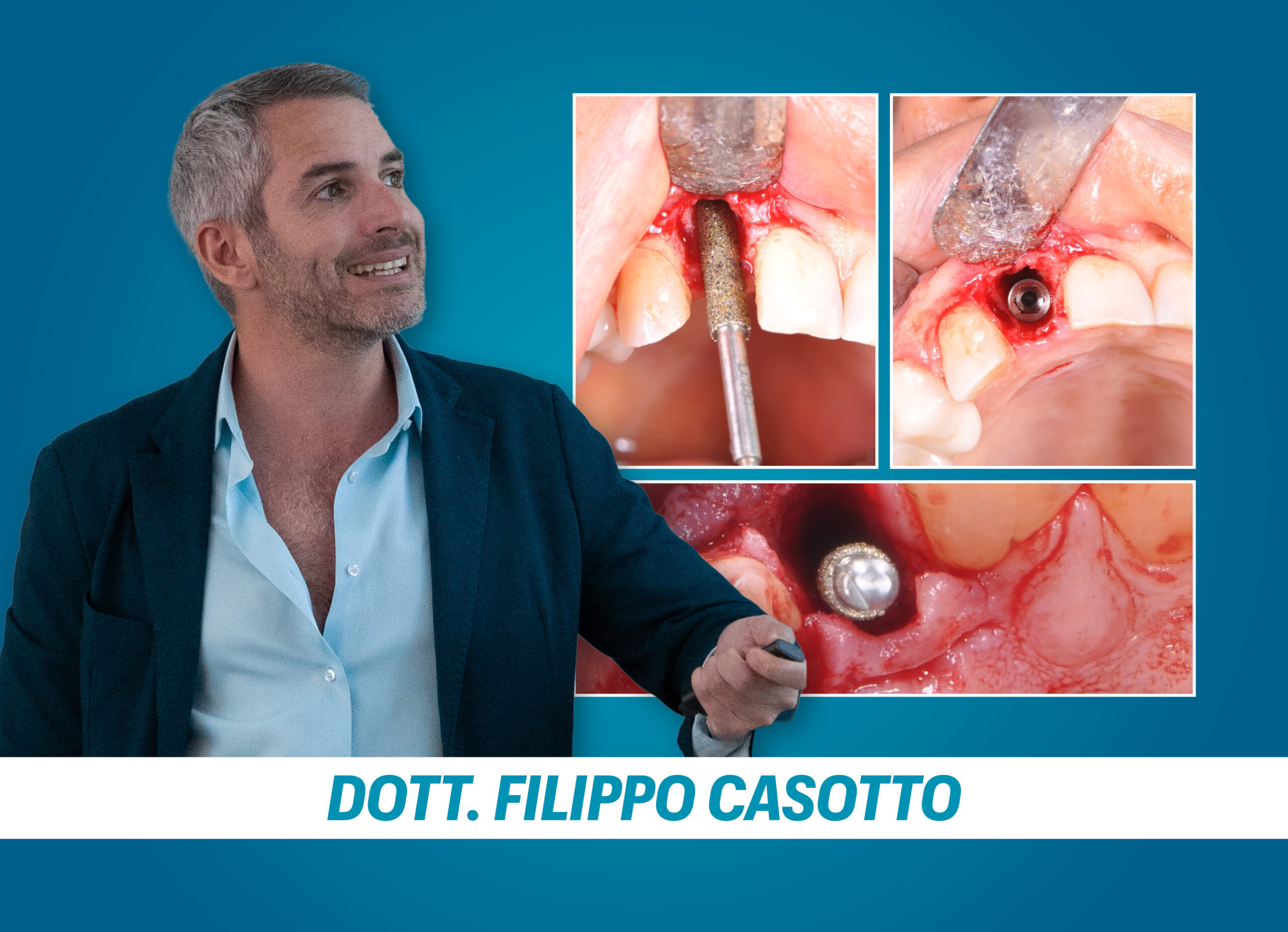 IMPIANTO POST ESTRATTIVO IN ZONA ESTETICA: dalla pianificazione alla finalizzazione