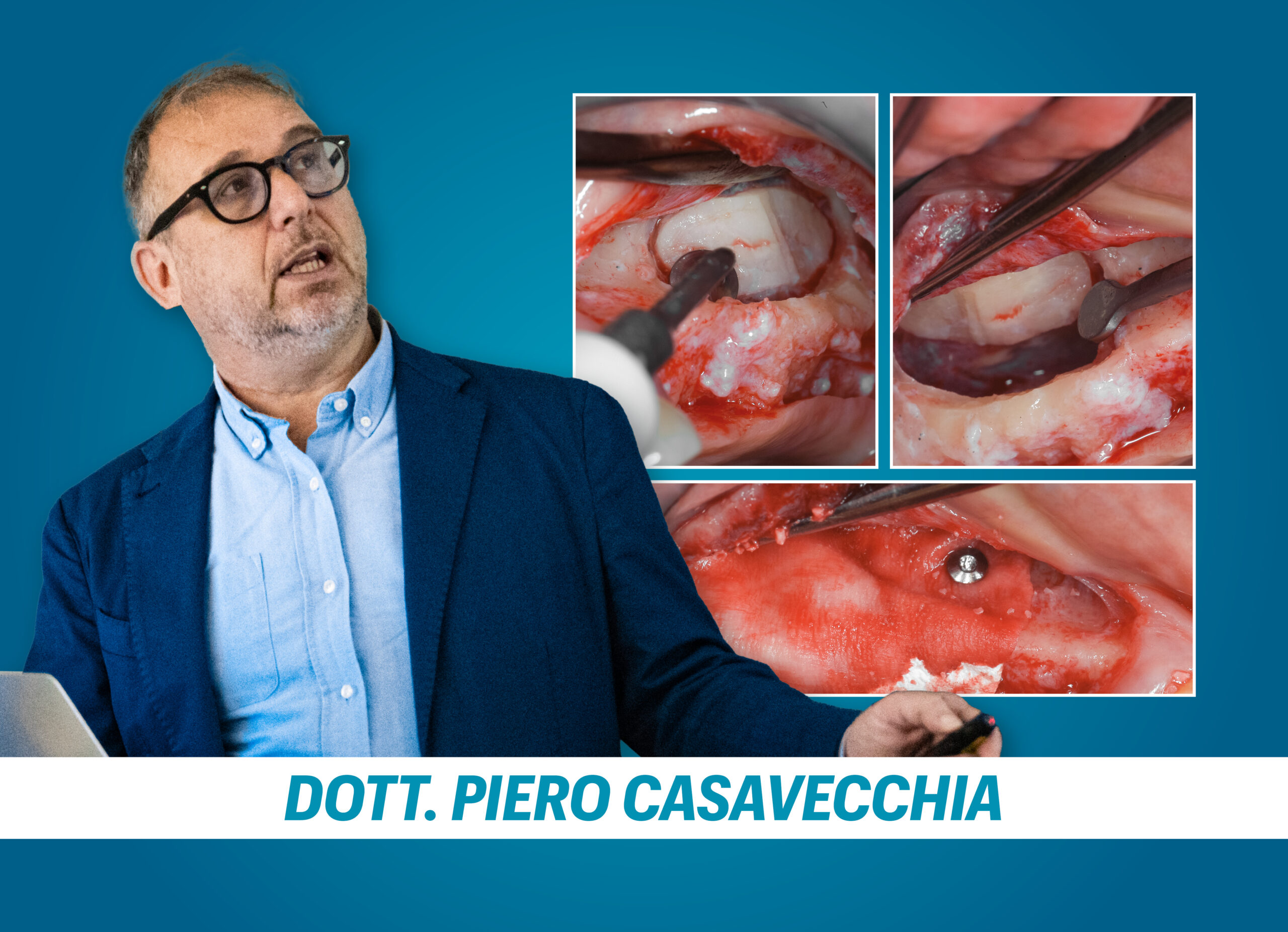 RIALZO DEL SENO MASCELLARE: tecnica crestale e laterale e gestione delle complicanze