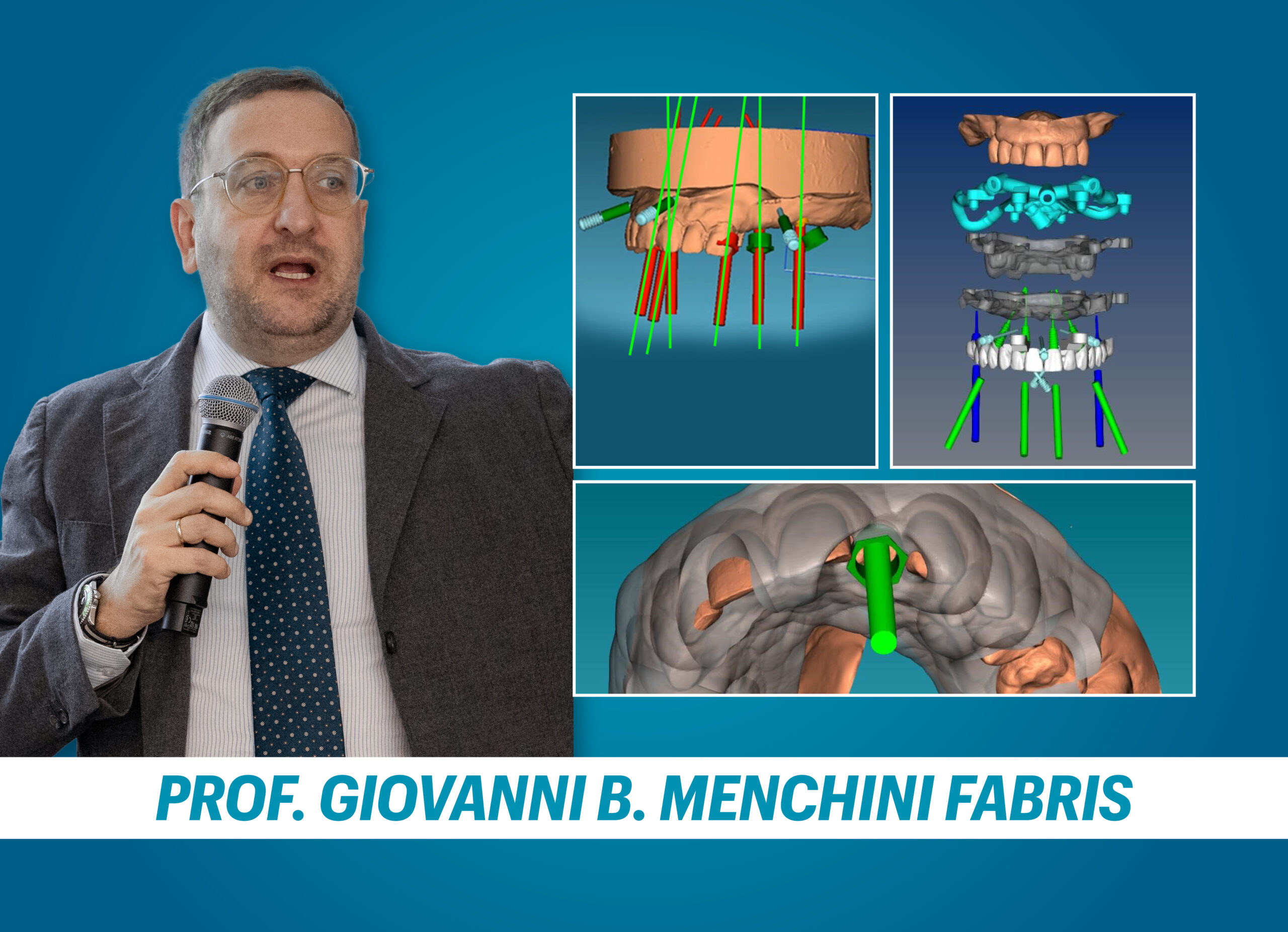 PROGETTAZIONE DELLA DIMA IN CHIRURGIA GUIDATA: aggiornamenti e design