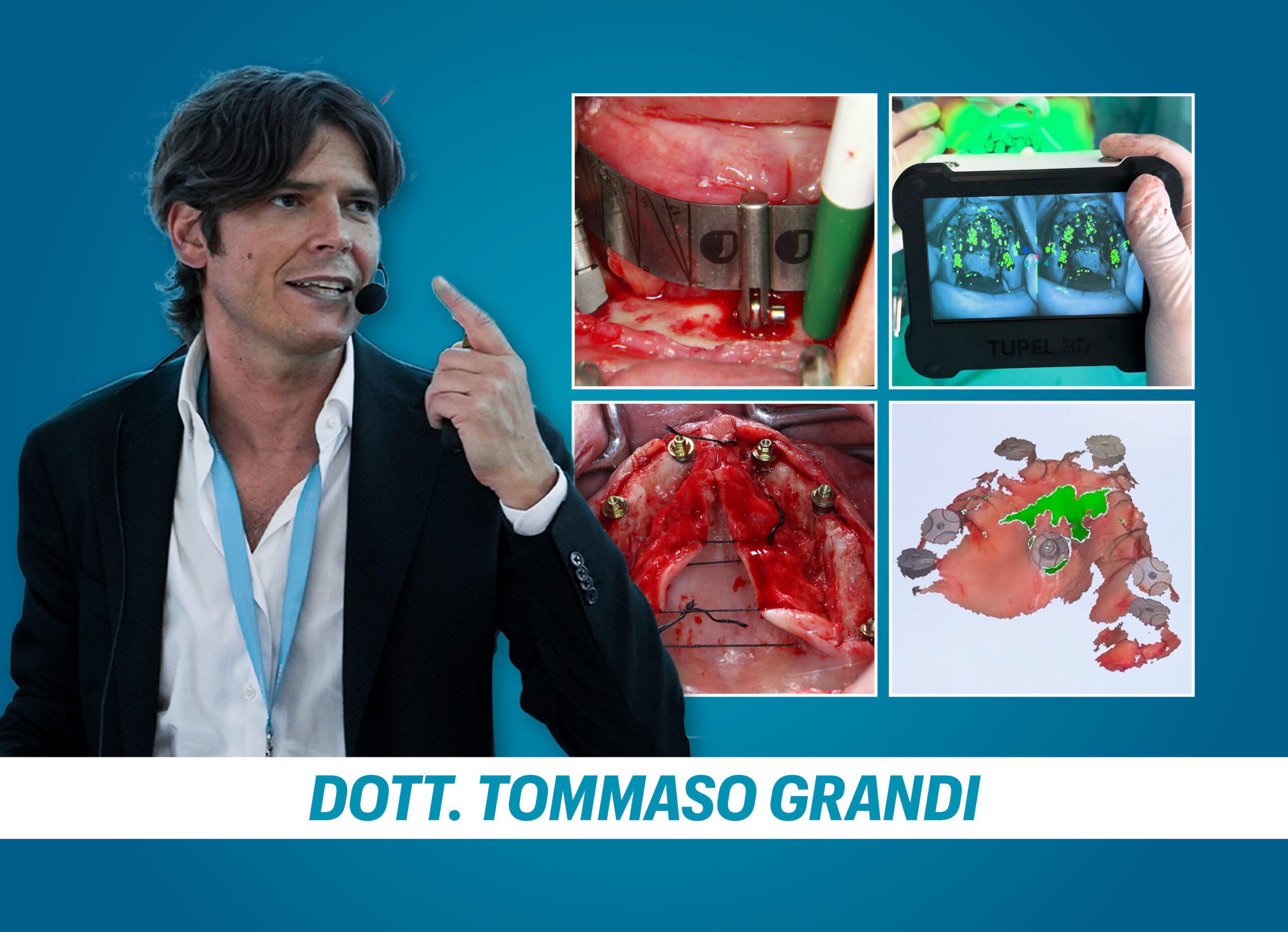 RIABILITAZIONE IMMEDIATA FULL ARCH ON 4/6 CON L’USO DEGLI IMPIANTI TILTATI. Azzera lo stress e porta a casa un protocollo standardizzato da attuare nella routine