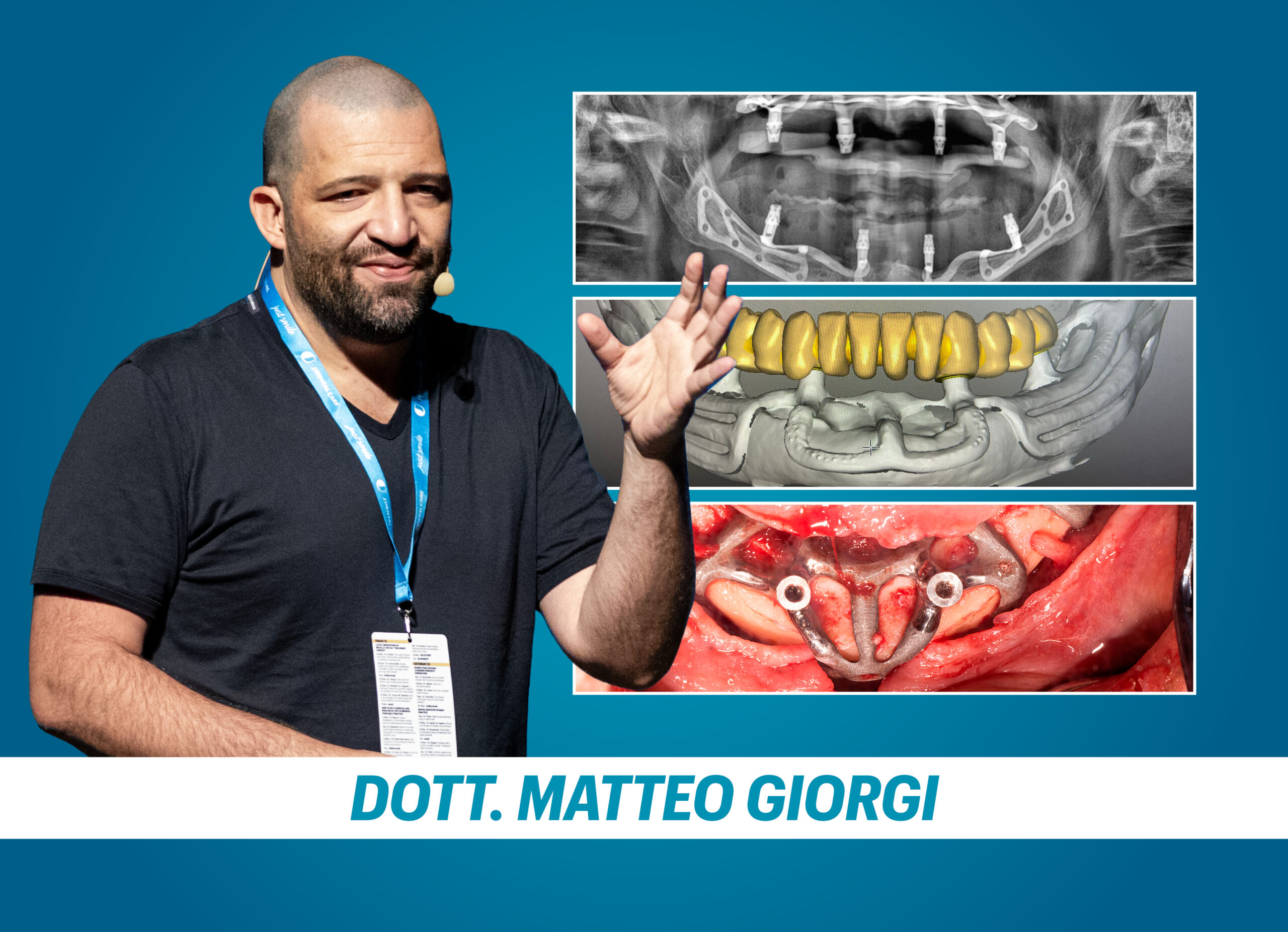 IMPIANTI IUXTAOSSEI: tecnica chirurgica e soluzioni protesiche