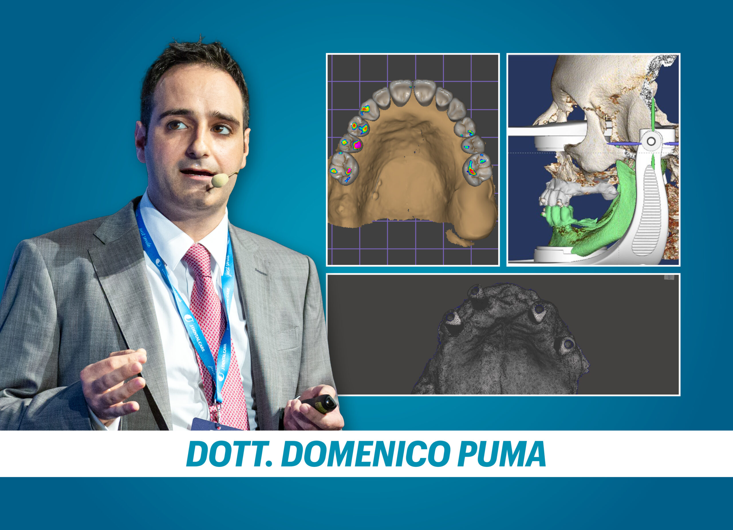 IL FULL ARCH A CARICO IMMEDIATO NELLA NUOVA ERA DIGITALE:  dalla ceratura diagnostica alla chirurgia guidata step-by-step per garantire estetica e funzione protesica
