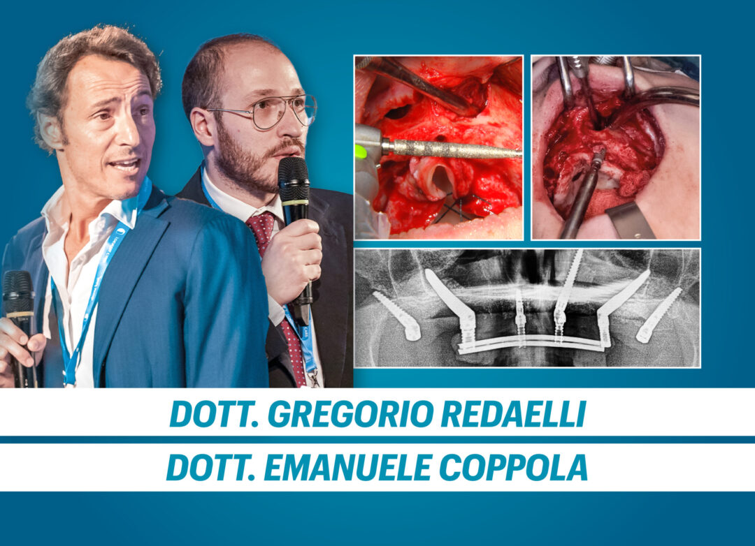 IMPLANTOLOGIA TRANS-NASALE. Pensa fuori dagli schemi: un nuovo punto di ancoraggio