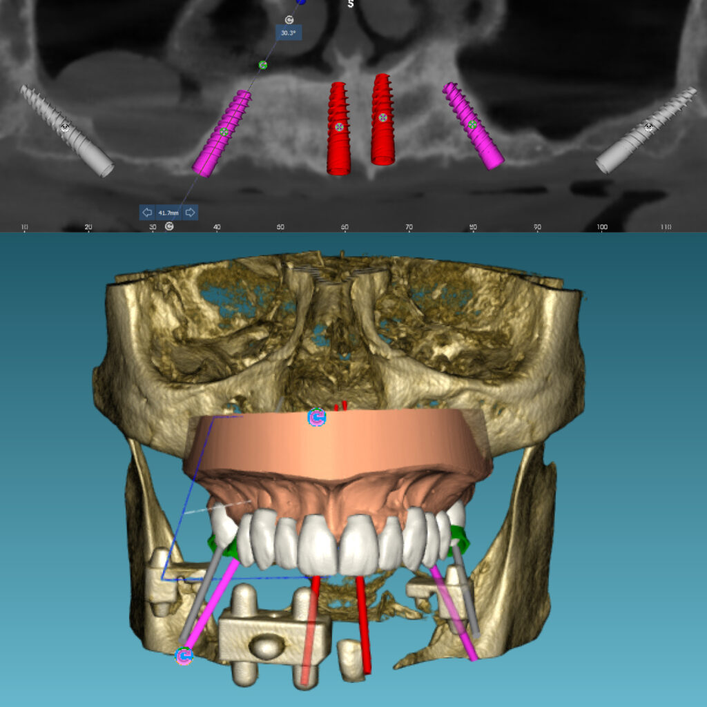 Diseño del caso clínico y planificación implantológica