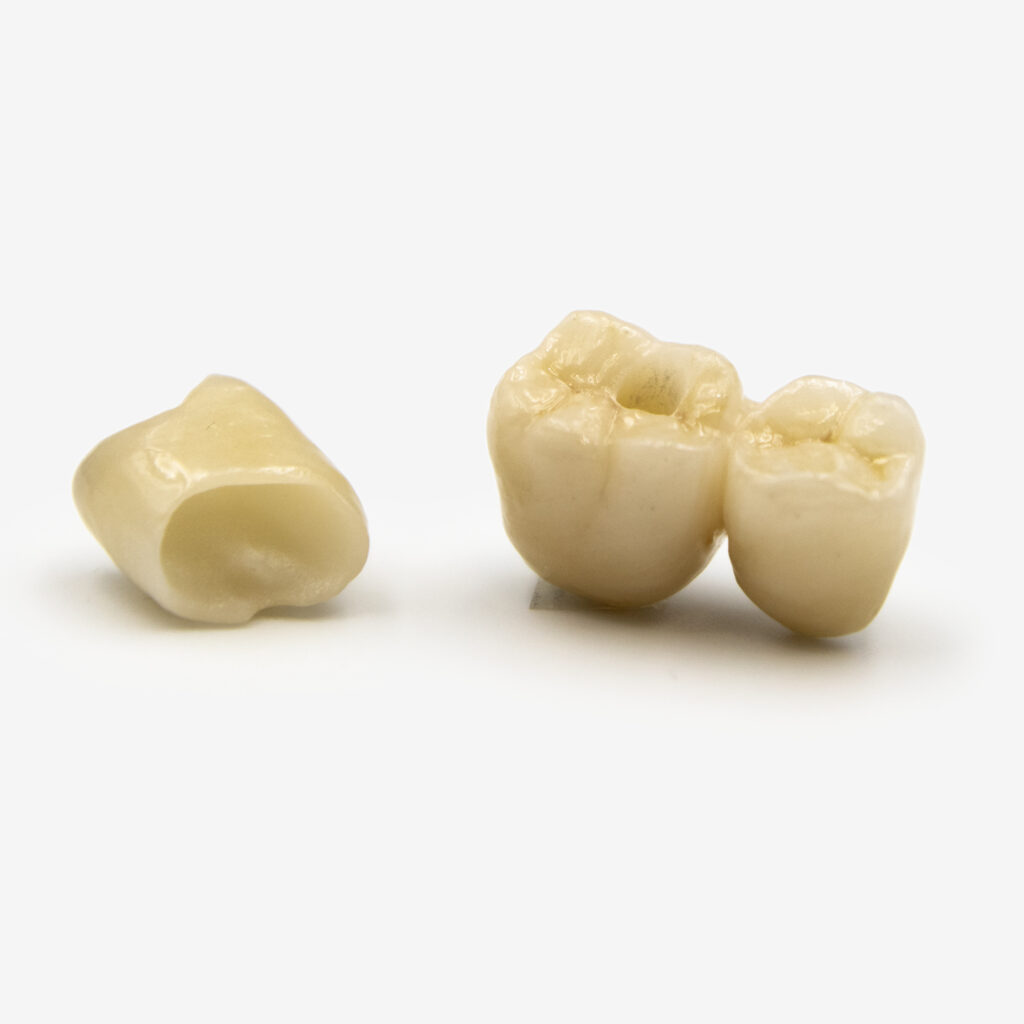 Coronas o puentes sobre dientes naturales